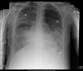 Röntgenfoto van een patiënt met ARDS