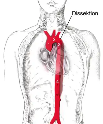 Dissectie van de aorta descendens (3), vanaf de linker sleutelbeenslagader tot aan de buikaorta (4). De aorta ascendens en de aortaboog (2) zijn niet aangedaan