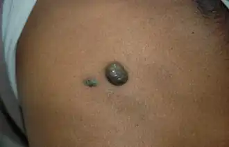 Vaatafwijking op de huid bij een patiënt met BRBNS