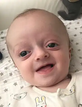 Baby met het Crouzon-syndroom