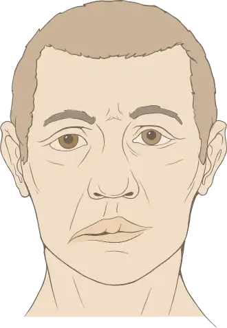 Diagram van een gezicht met Bellse parese.