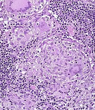 Een niet-necrotiserend granuloom van een patiënt met de Ziekte van Crohn, zoals dat er bij microscopisch weefselonderzoek uit kan zien. Linksboven tegen de rand een meerkernige reuscel