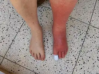 Cellulitis van linkerbeen