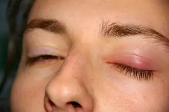 Ooglid met een chalazion