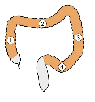 alt=Schematische voorstelling van de onderdelen van de karteldarm:
1. Colon ascendens
2. Colon transversum
3. Colon descendens
4. Colon sigmoideum