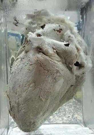 Pericarditis constrictiva