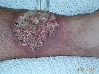 Pyoderma gangraenosum aan het been bij een patiënt met de ziekte van Crohn, met paarse opgeworpen wondranden.