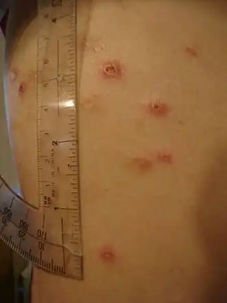 Huidzweren bij een patiënt met de ziekte van Crohn