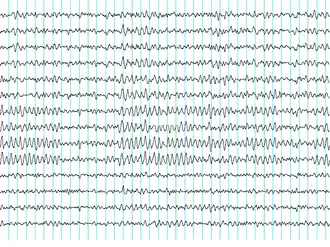 Een EEG (elektro-encefalogram)