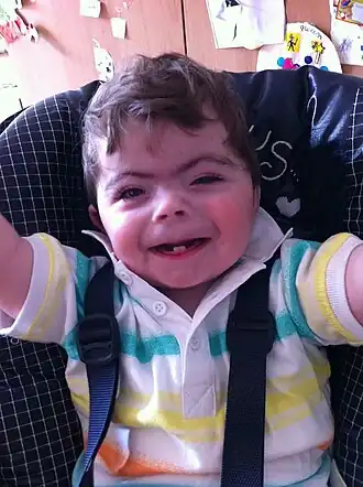 Jongen met het syndroom van Cornelia de Lange