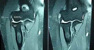 Epicondylitis lateralis