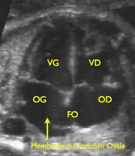 {VG: linker ventricel, VD: rechter ventrikel, OG: linkeratrium, OD: rechteratrium, FO: foramen ovale
