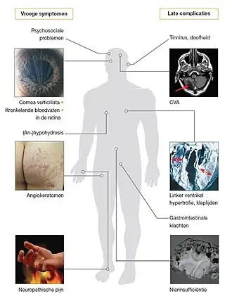 Vroege symptomen en late complicaties bij de ziekte van Fabry