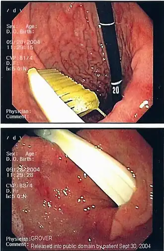 Endoscopie afbeelding van een tandenborstel in het lichaam van een mens