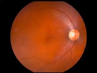 Fundusfoto van het netvlies