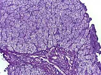 Glycogeenstapelingsziekten