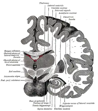 Coronale doorsnede van de hersenen. De nucleus subthalamicus aangegeven als nucleus of Luys.