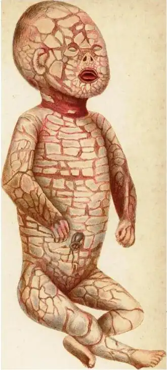 Harlequin-foetus (1886).