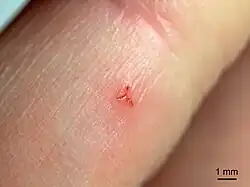 Litteken van een beet van de medicinale bloedzuiger