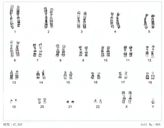 Karyotype van klinefelter