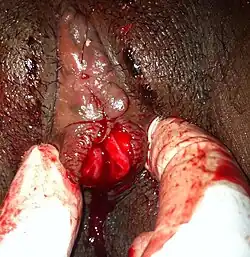 Vulva van een 21-jarige Ethiopische vrouw die infibulatie ondergaan heeft op achtjarige leeftijd en de-infibulatie krijgt bij een arts.