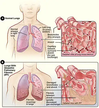 Idiopathische pulmonale fibrose