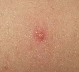 Folliculitis, enkele laesie