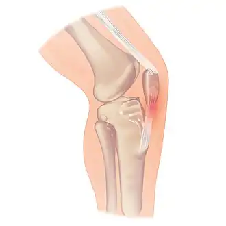 Patellatendinopathie