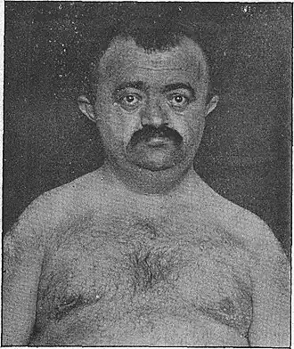 Dysostosis cleidocranialis