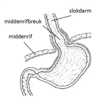 Hernia diaphragmatica