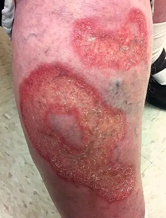 necrobiosis lipoidica op een scheen