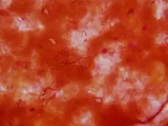 Nocardia in een hersenbiopsie