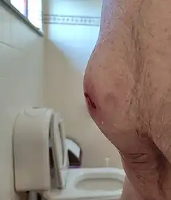 Zijdelings aanzicht van een stomabreuk