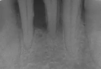 botverlies bij parodontaal aangetaste ondersnijtanden