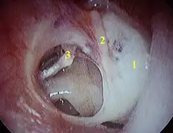 Geperforeerd trommelvlies (van linkeroor):1 - Tympanosclerose, 2 - Hamer, 3 - bovenkant van stijgbeugel