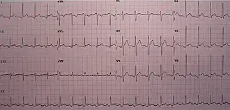 Een ECG passend bij pericarditis.  Specifiek voor pericarditis is de ST elevatie in meerdere afleidingen en een minimale reciproke ST depressie in aVR.