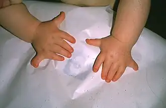 Polydactylie