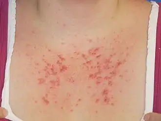 Polymorfe lichteruptie