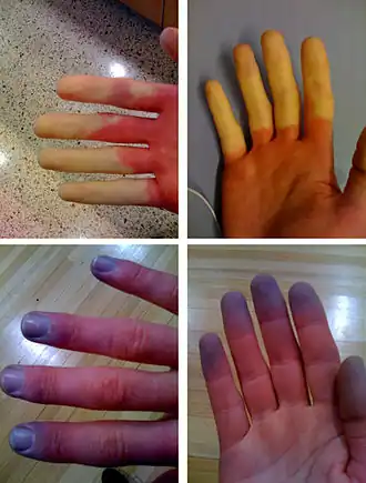 Verschillende fases van het syndroom van Raynaud
