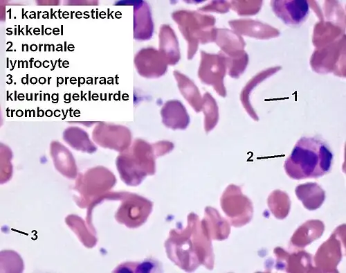 1. karakteristieke sikkelcel 2. normale lymfocyt 3. door preparaat kleuring gekleurde trombocyt