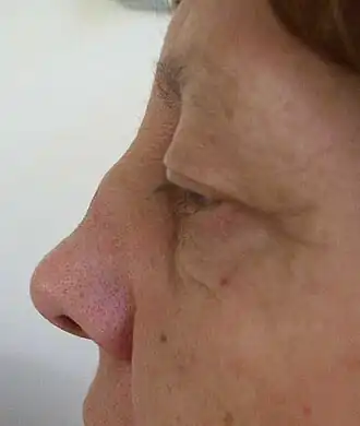 Een ingezakte neus, symptoom van polychondritis.