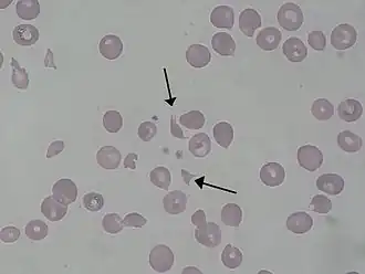 Schizocyten bij een patiënt met het hemolytisch-uremisch syndroom