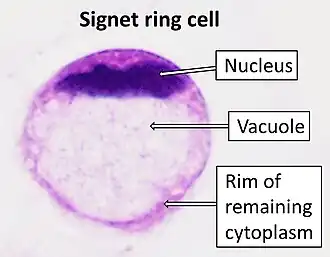 Zegelringcel, zoals te zien bij een colonadenocarcinoom met een vacuole van mucine.