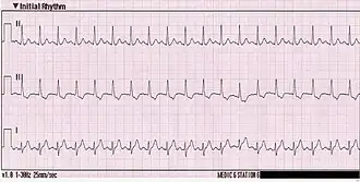 ECG bij een sinustachycardie. Hier heeft het hart een ritme van 150 slagen per minuut.