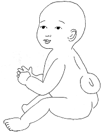 Tekening van een baby met spina bifida aperta