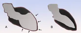 Het hart met de cardiomyopatie in vergelijking met de normale situatie.
