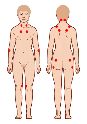 criteria voor fibromyalgie negen gepaarde tenderpoints (1990 American College of Rheumatology criteria for fibromyalgia).