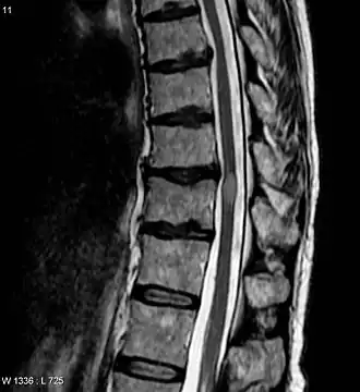 MRI met myelitis transversa (lichte, ovale vorm midden rechts. De patient herstelde 3 maanden later.