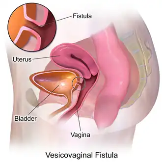 Fistula vesicivaginalis