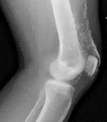 Röntgenfoto van een knie bij dermatomyositis.